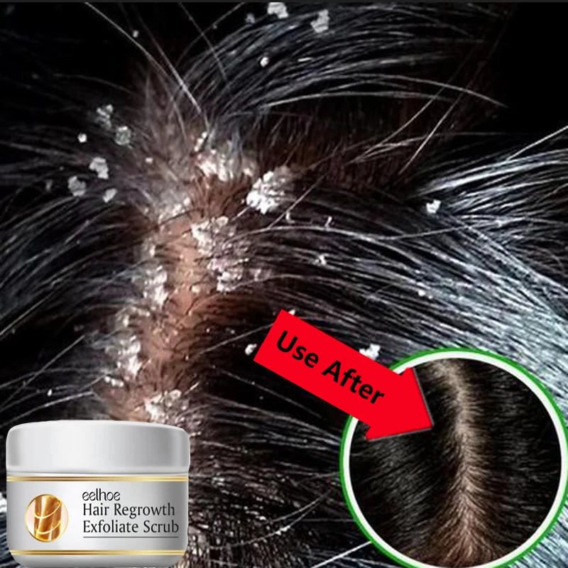 빠른 비듬 방지 헤어 트리트먼트 스크럽 가려움증 개선  - Scalp Scrub Exfoliant 리뷰 및 가격