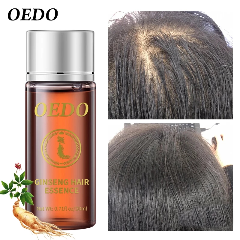 20ML 인삼 모발 성장 에센스 탈모 방지 액체 손상  - Hair Care Ginseng 리뷰 및 가격
