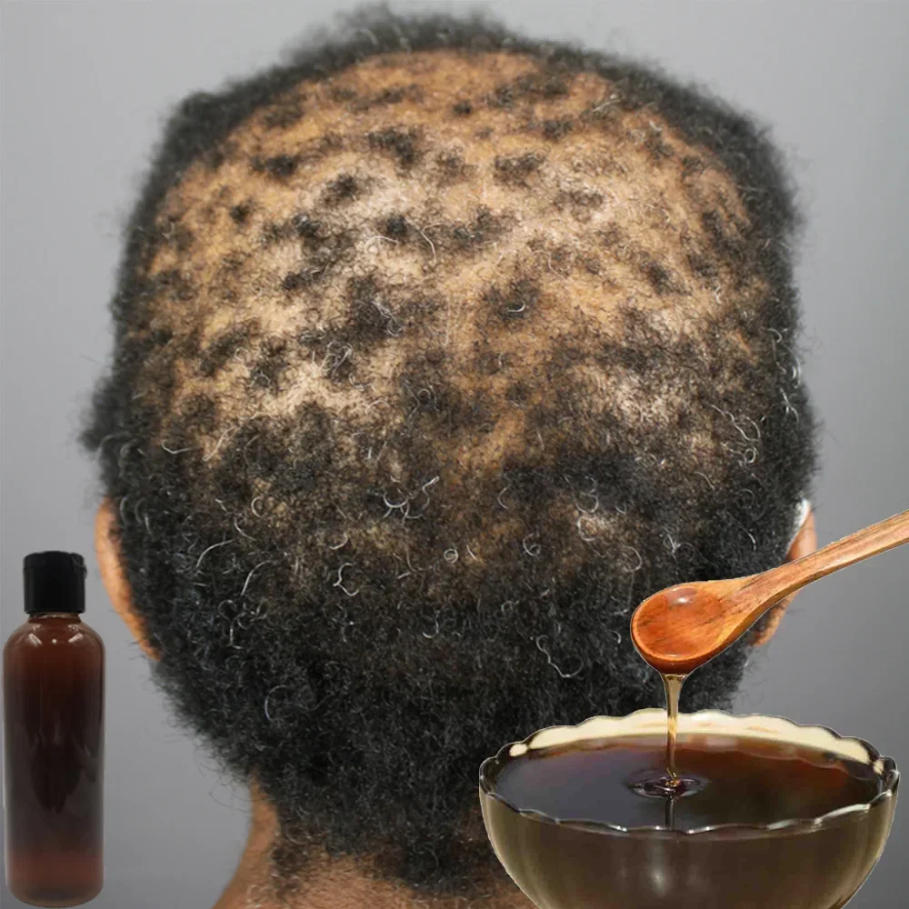아프리카 여성 견인 탈모증 치료 탈모 치료 가발 제거  - Hair Care Ginseng 리뷰 및 가격